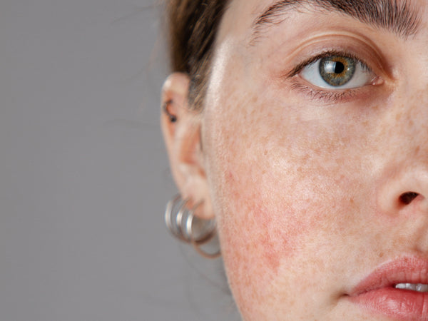 Skintegra Hiperpigmentación: todo lo que necesitas saber